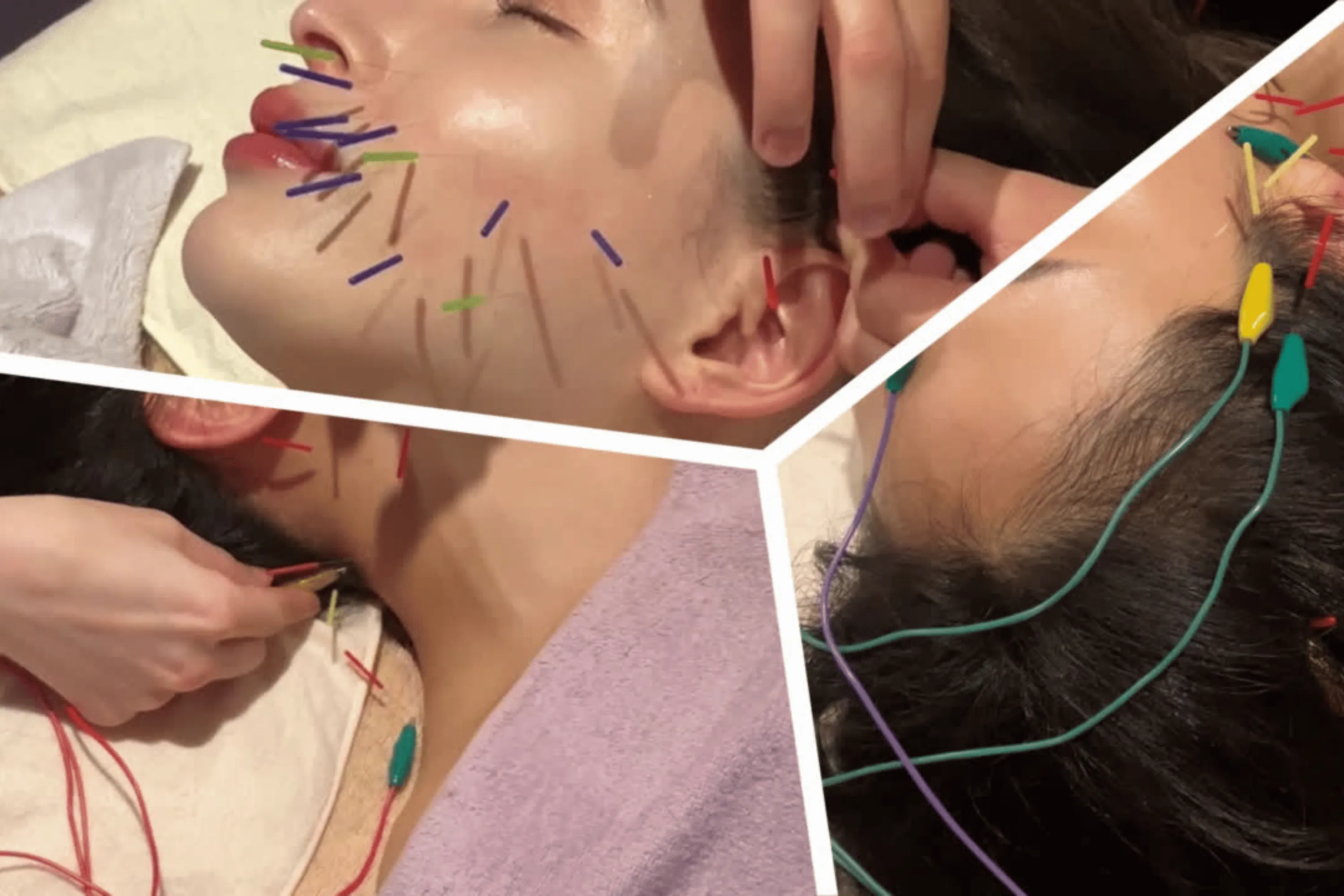 ほうれい線に関するお悩み｜リフトアップ特化型美容鍼〈シーバイ